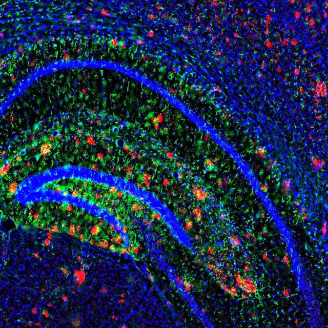 Placas de amiloide en el cerebro