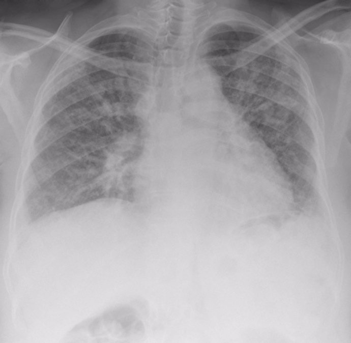 Fibrosis quística