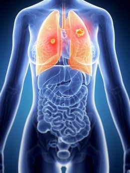 19040628 - 3D Rendered Illustration Of The Female Anatomy - Lung Cancer