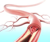 La mitad de los pacientes con hipercolesterolemia no cumplen adecuadamente los tratamientos prescritos