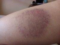 PSOE denuncia una plaga de mosquito tigre, "que provoca múltiples atenciones médicas" en la pedanía de Puente Tocinos