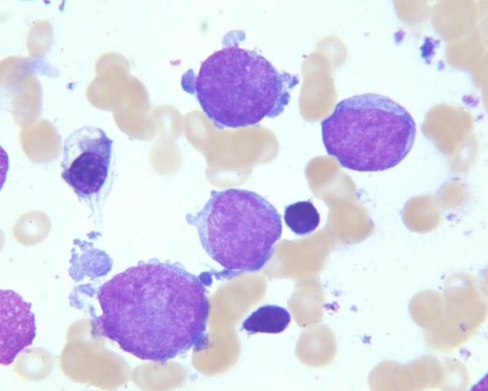 Leucemia megacarioblástica aguda 