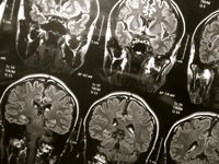 Experto destaca que la radiocirugía duplica la esperanza de vida en casos de metástasis cerebral