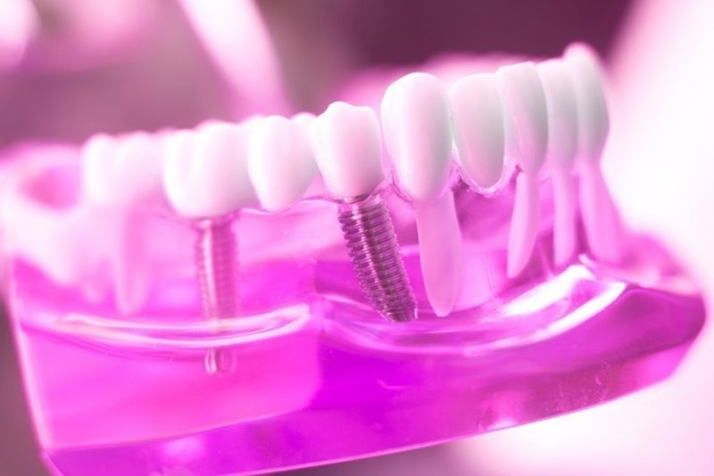 Higiene del implante dental en tres pasos