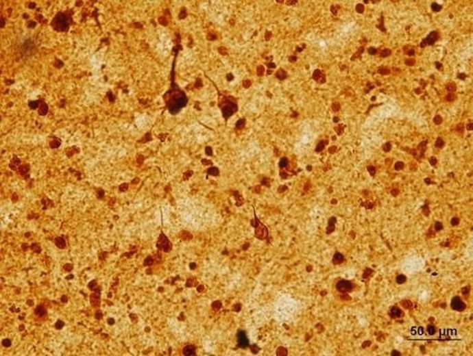 Nevos datos sobre cómo mueren las neuronas en el Alzheimer