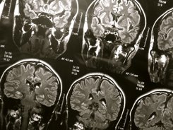 Foto: Detectan infecciones causadas por hongos en cerebros de pacientes fallecidos con Alzheimer (FLICKR/WYINOUE) 