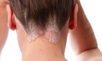 Psoriasis: una enfermedad que afecta a medio millón de peruanos