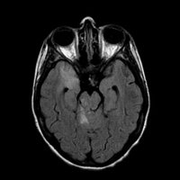 Cada año cerca de 120.000 personas sufren un ictus en España, de los cuales un 50% quedan con secuelas discapacitantes