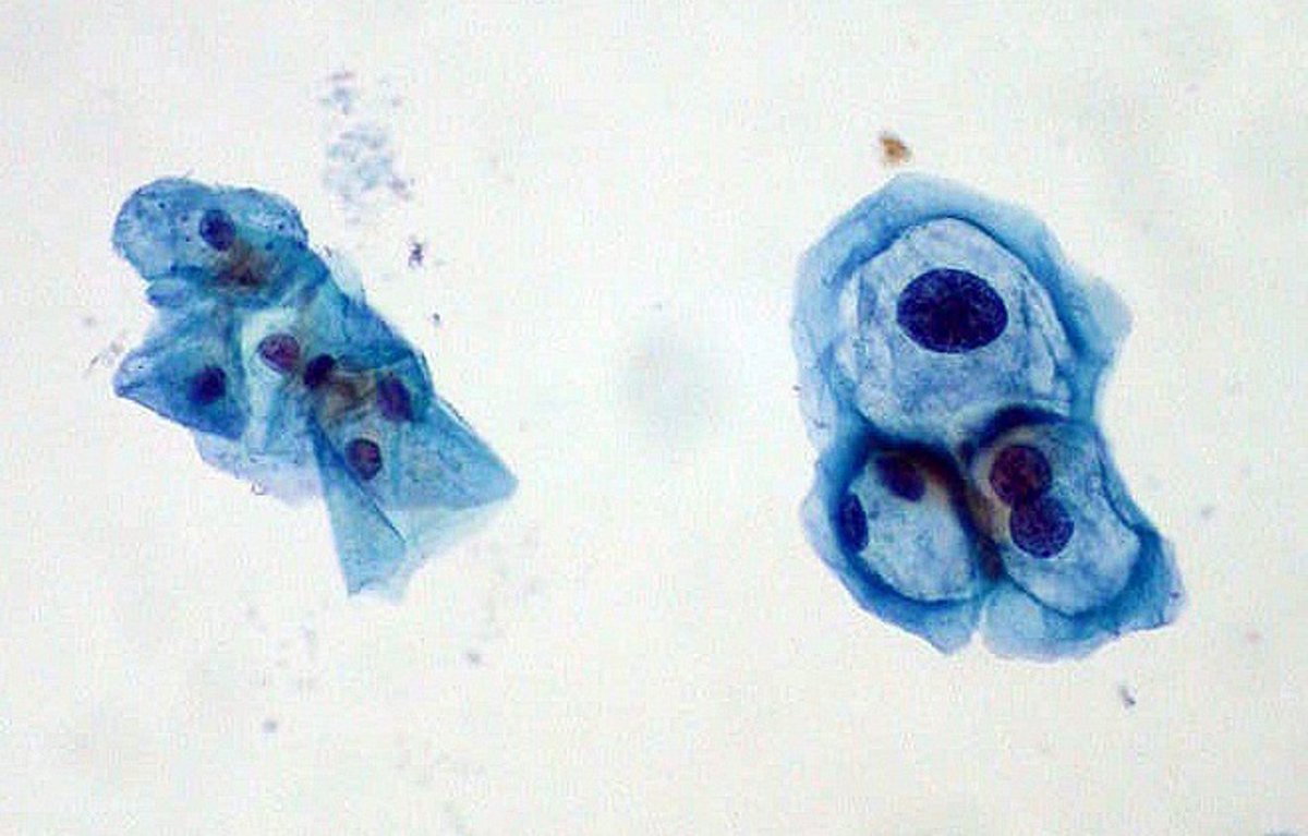 Virus del papiloma genotipos