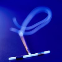 El DIU puede proteger contra el cáncer de cuello uterino