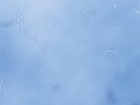 La cirugía láser, alternativa para 'espantar' las 'moscas flotantes' de los ojos