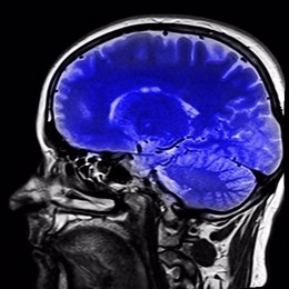 Resonancia magnética del cerebro