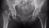 Foto: Las fracturas por osteoporosis en mujeres aumentan el riesgo de futuras fracturas