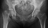Las fracturas por osteoporosis en mujeres aumentan el riesgo de futuras fracturas