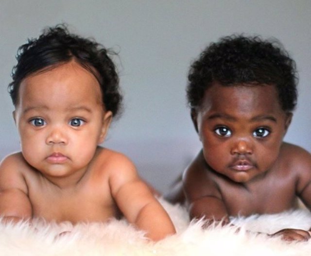 Hermanas gemelas con distintas tonalidad de piel