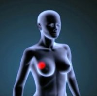 Expertos ven necesario mejorar la información sobre prevención del cáncer de mama y las terapias individualizadas