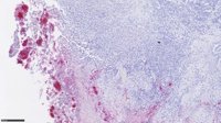 Investigadores mejoran el tratamiento de la metástasis de cáncer colorrectal con una muestra de sangre