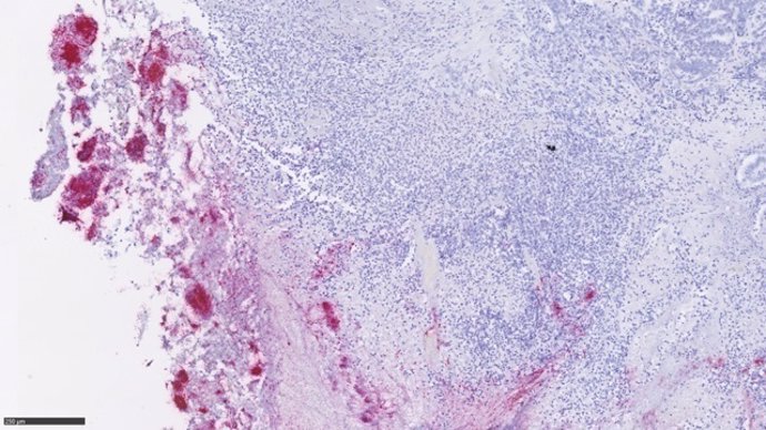 Imagen de un tumor colorrectal con un gran número de Fusobacterias, en rojo