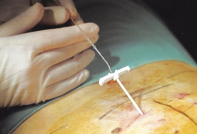 Neuromodulación de las raíces sacras para tratar la incontinencia fecal