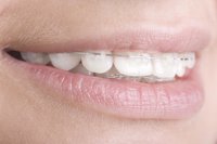 Más del 50% de los españoles llevan, o han llevado, ortodoncia