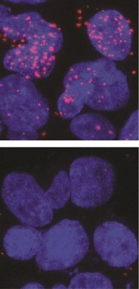 Descubren una diana terapéutica para casos resistentes de cáncer de próstata