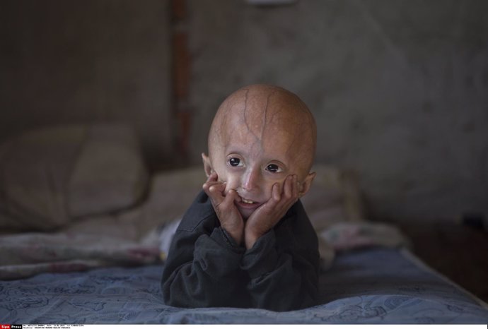 Franco Villavicencio, niño de cuatro años que sufre progeria