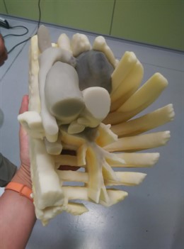 Modelo 3D del pecho de la niña realizado por Andaltec.