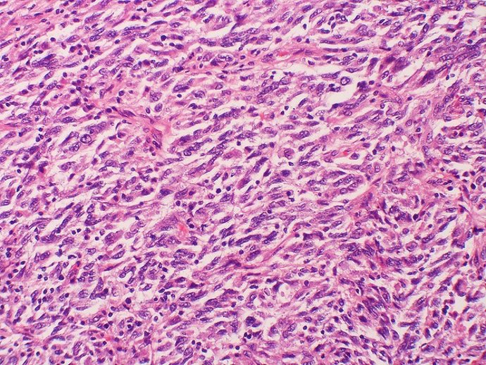 Metastasis melanoma, cáncer