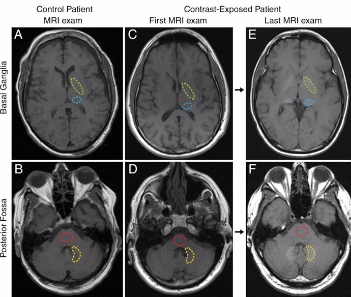 Presencia de gadolinio en el cerebro