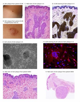 Un nou mètode permet avançar la detecció de Neurofibromatosis tipus 2