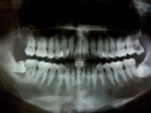 Periodontitis