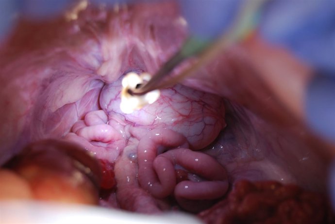 Una operación con el dispositivo Rutilight del Hosp.Germans Trias i Pujol