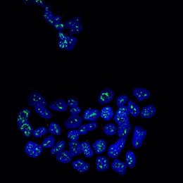 Núcleos de células metastásicas de cáncer de mama con la proteína MSK1 en verde