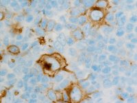 En España podría haber 20.000 pacientes con algún tipo de linfoma, 11.000 con leucemia y 6.000 con mieloma múltiple