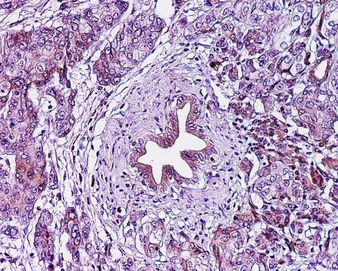 Adenocarcinoma ductal pancreático, cáncer páncreas