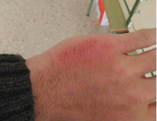Mano del profesor inflamada por el golpe de un alumno