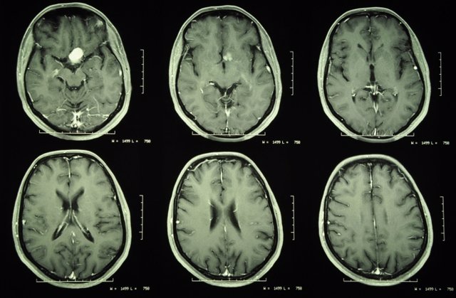 Meningioma, tumor cerebro