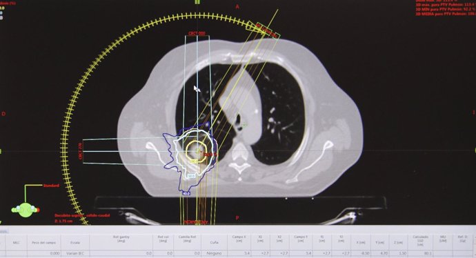 Imagen radiológica de la nueva técnica de radioterapia de Son Espases