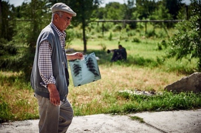 Hombre con tuberculosis