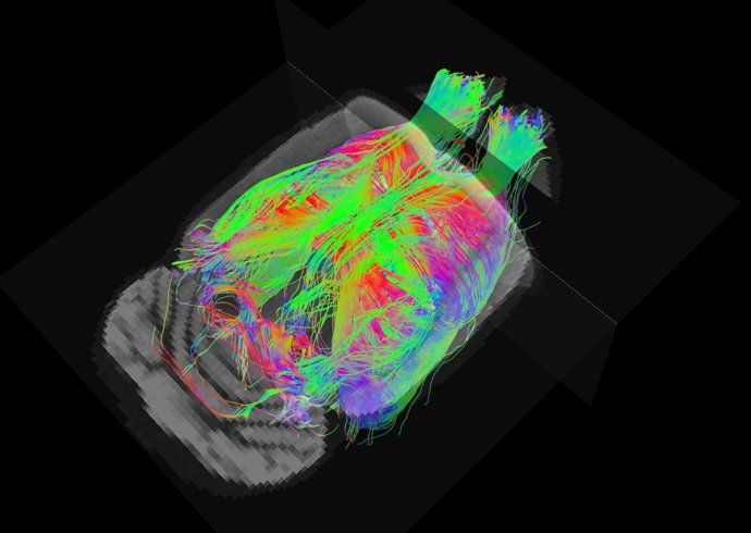 Estudi sobre la ressonància magnètica en l'Alzheimer