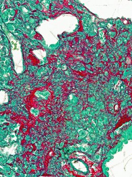 Identifican un nuevo objetivo molecular para la fibrosis pulmonar idiopática