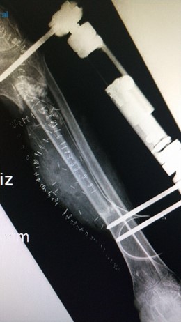 Radiografía de trasplante 