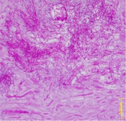 Tinción histológica de un corte de riñon infectado por candida 