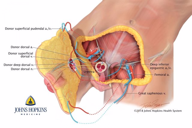 Diagrama del primer trasplante de pene y escroto en el mundo