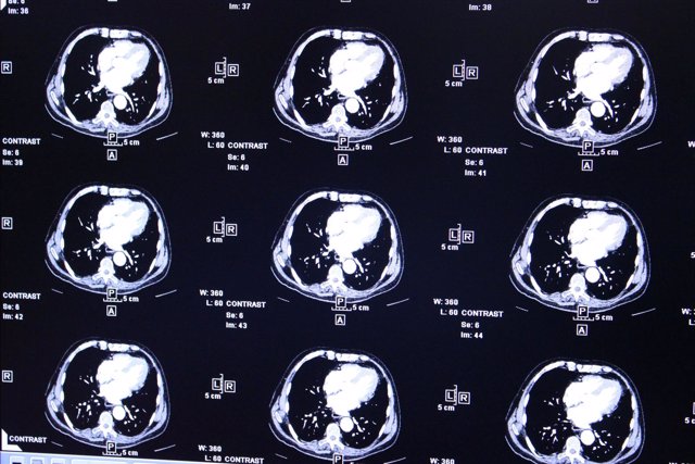 Radiografías, electroencefalogramas, actividad del cerebro, tumor