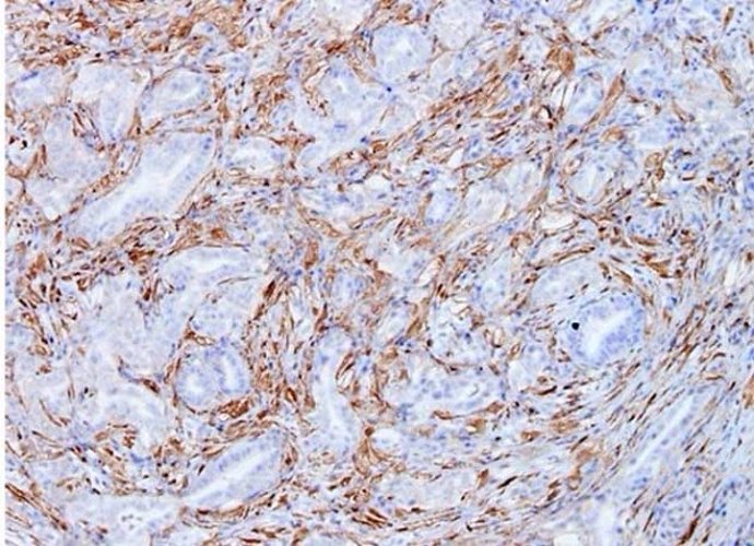 Células tumorales de cáncer de páncreas, mostrando en marrón la Galectina 1