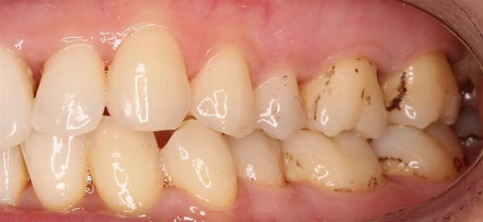  Aspecto De Las Pigmentaciones Negras En El Esmalte Próximo A Las Encías