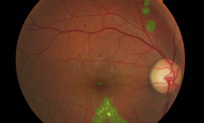 Desarrollan un nuevo sistema para detectar de forma temprana daños en la retina