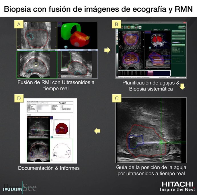 Biopsia con fusión de imágenes de ecografía y RMN