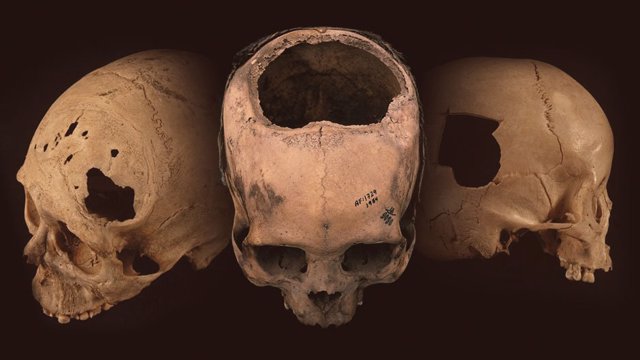 Antiguos cráneos con evidencia de trepanación
